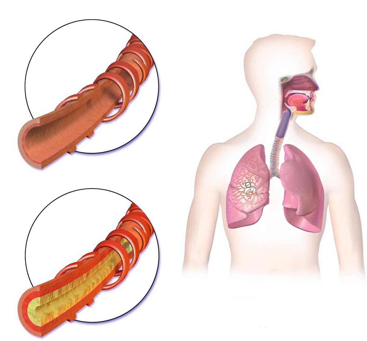 Hemoptysis - Wikipedia