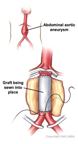 Vascular surgery - Wikipedia