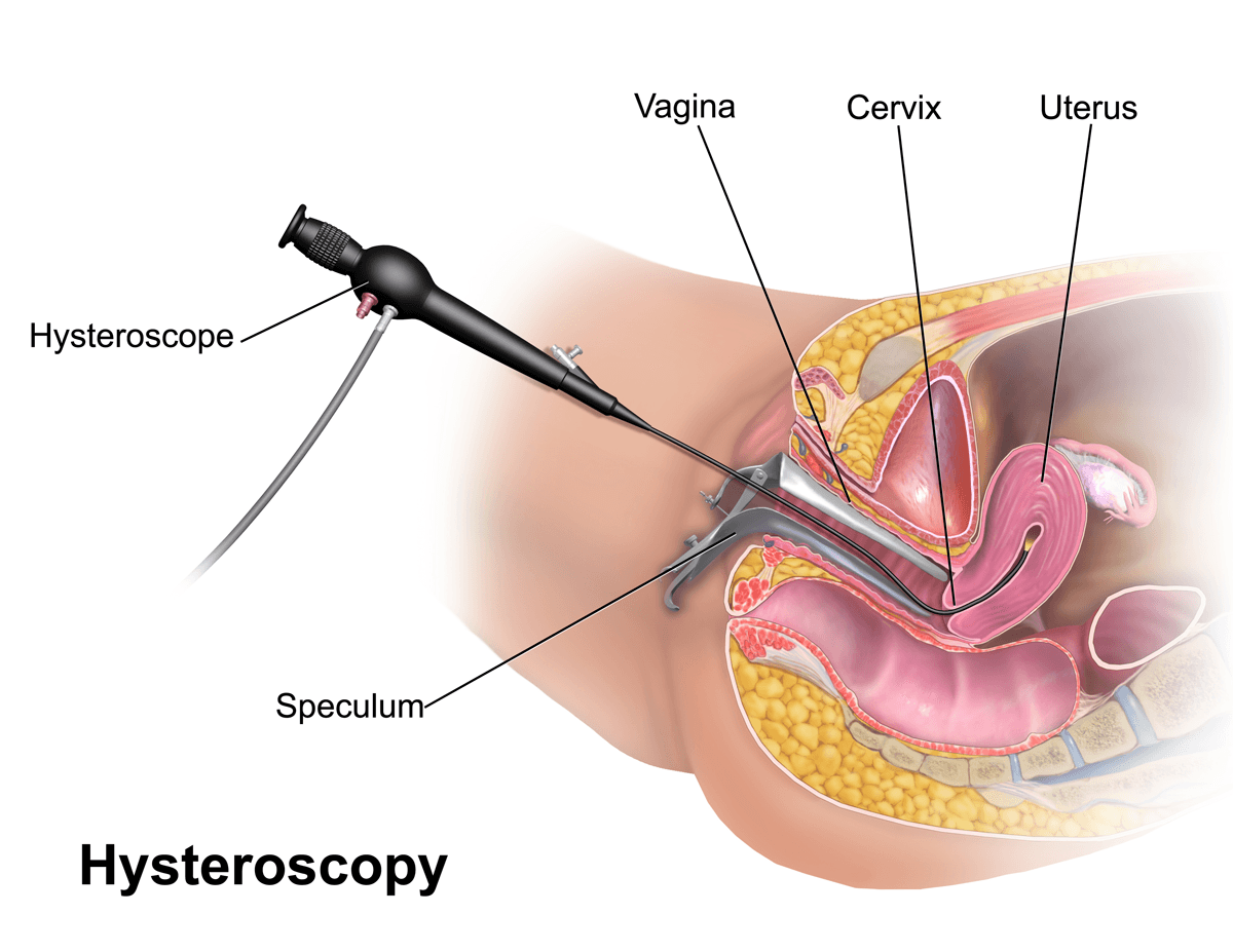 Hystéroscopie — Wikipédia