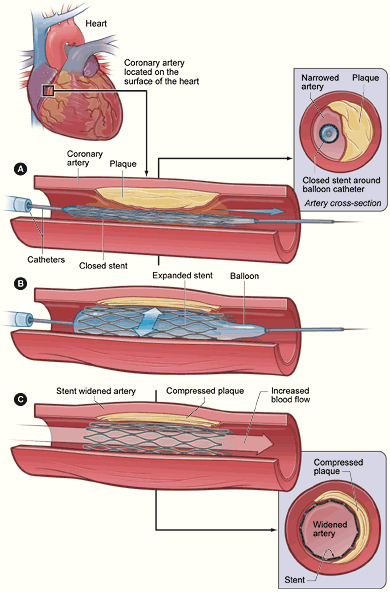 Restenosis - Wikipedia