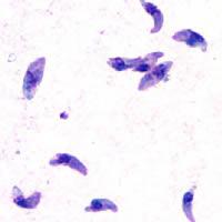 Toxoplasmosis - Wikipedia