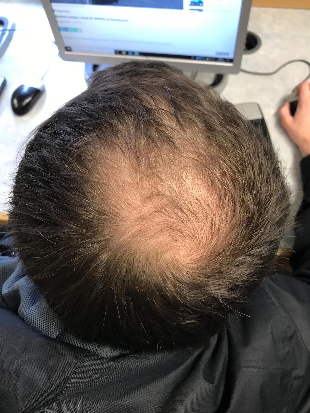 Pattern hair loss - Wikipedia