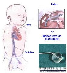 Atrial septostomy - Wikipedia