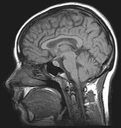 Idiopathic intracranial hypertension - Wikipedia