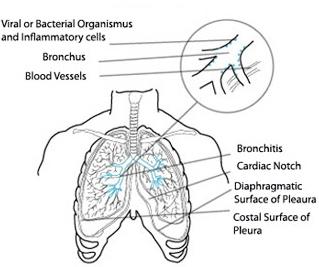 Bronchite — Wikipédia