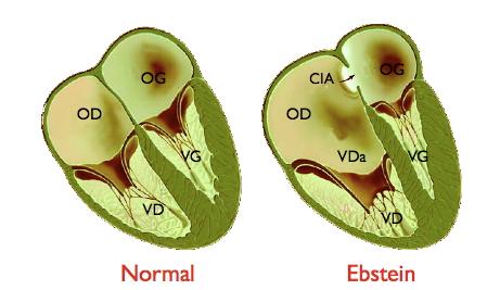 Anomalie d'Ebstein — Wikipédia