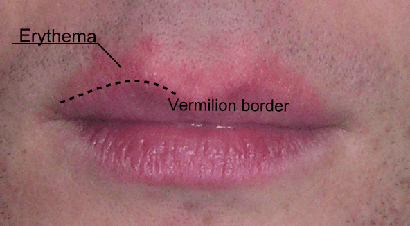 Vermilion border - Wikipedia