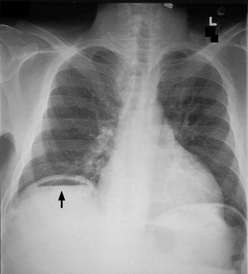 Pneumoperitoneum - Wikipedia