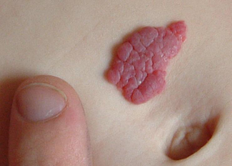 Infantile hemangioma - Wikipedia