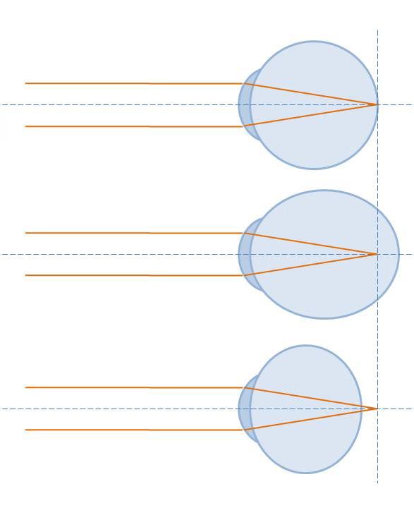 Refractive error - Wikipedia