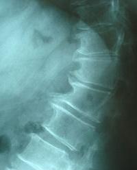 Spondylosis - Wikipedia