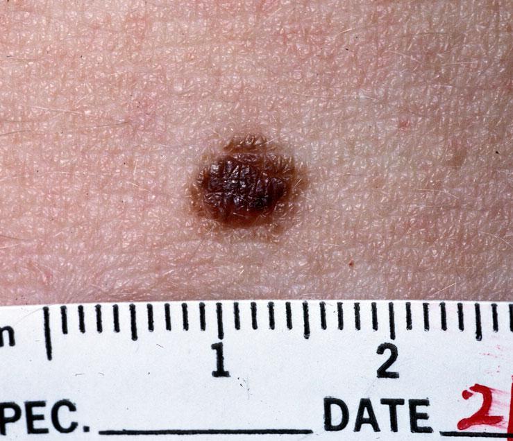 Nevus - Wikipedia