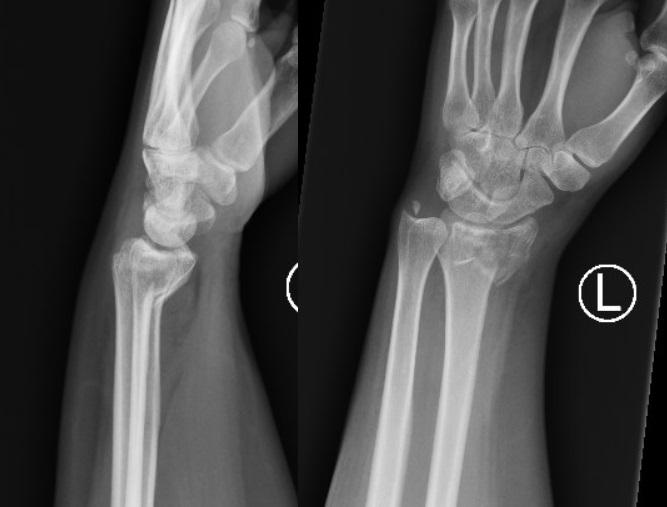 Smith's fracture - Wikipedia