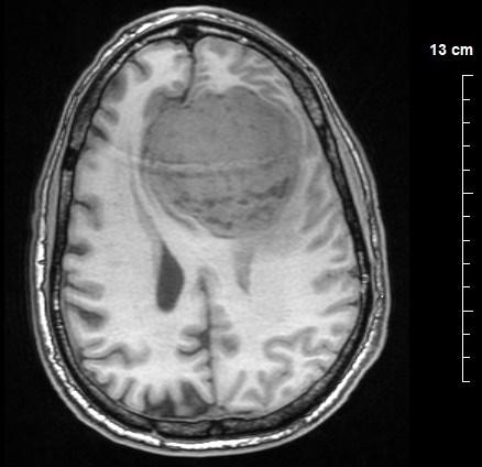 Meningioma - Wikipedia