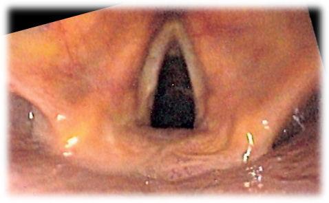 Laryngoscopy - Wikipedia