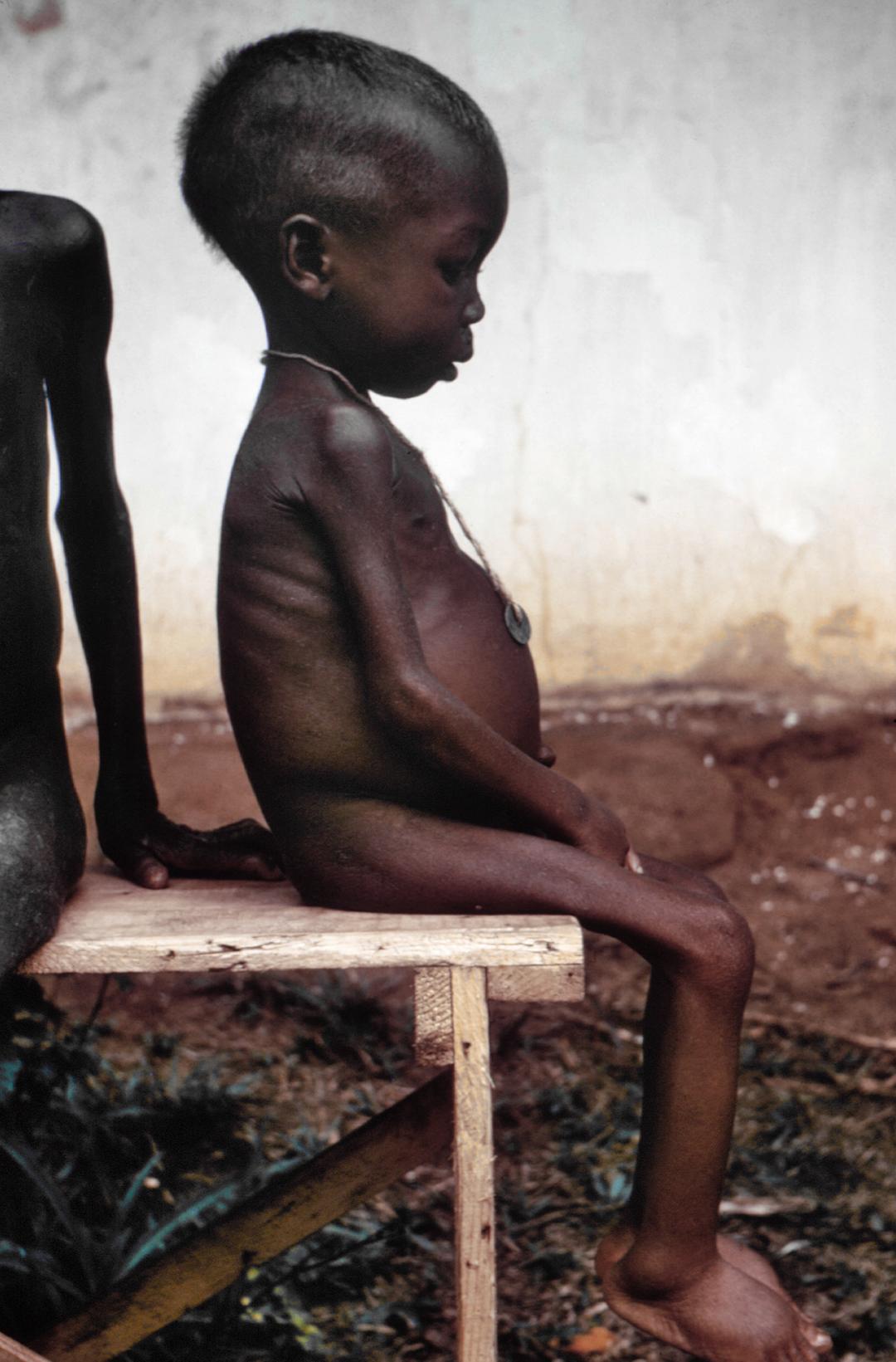 Kwashiorkor - Wikipedia