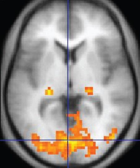 Functional magnetic resonance imaging - Wikipedia