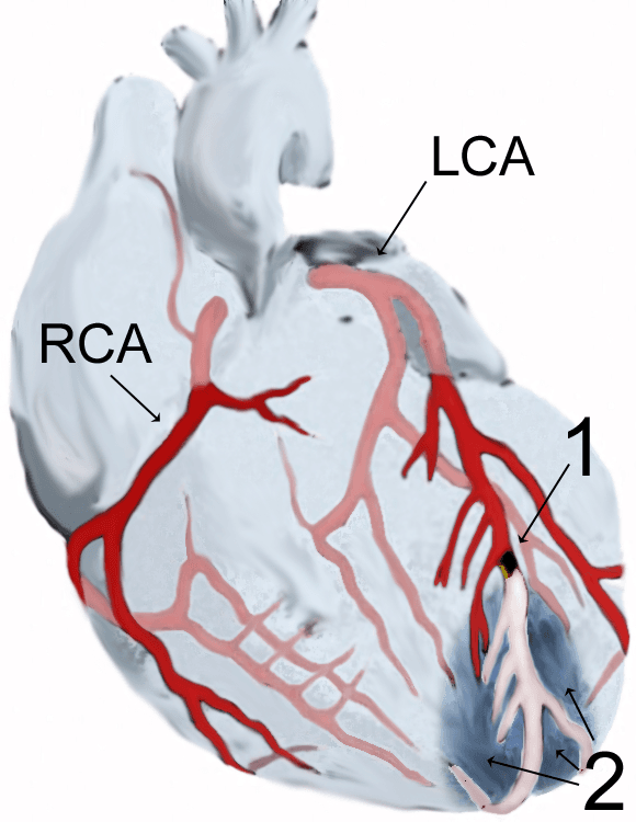 Infarctus du myocarde — Wikipédia