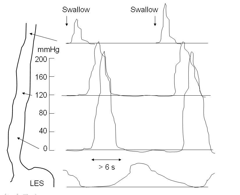 Esophageal motility study - Wikipedia