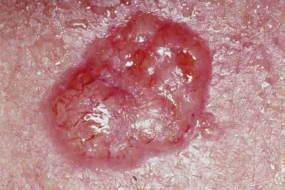 Skin cancer - Wikipedia