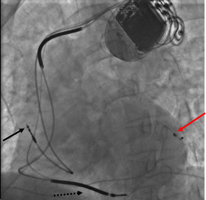 Resynchronisation cardiaque — Wikipédia