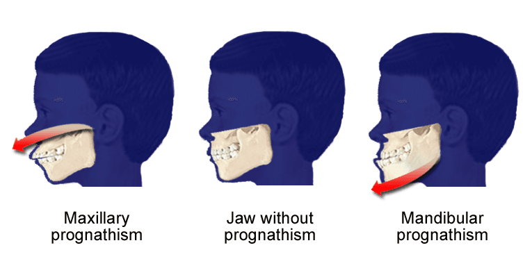 Prognathism - Wikipedia