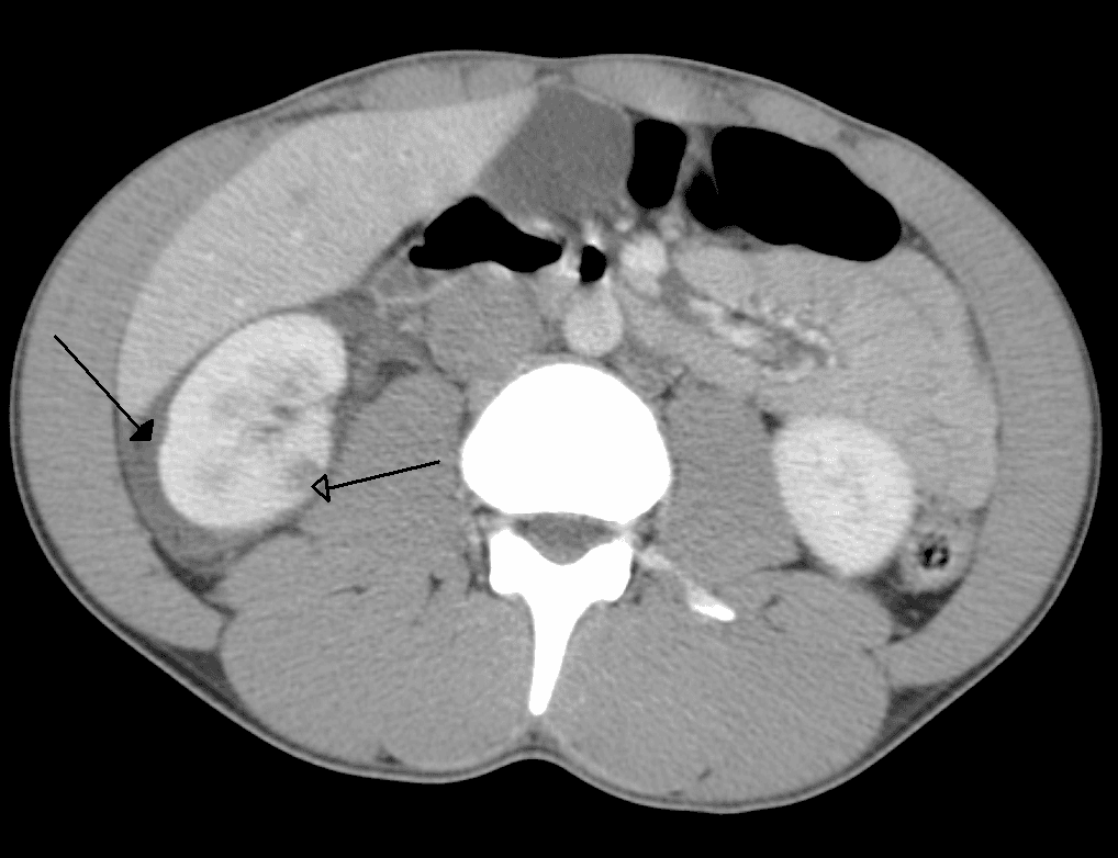 Abdominal trauma - Wikipedia