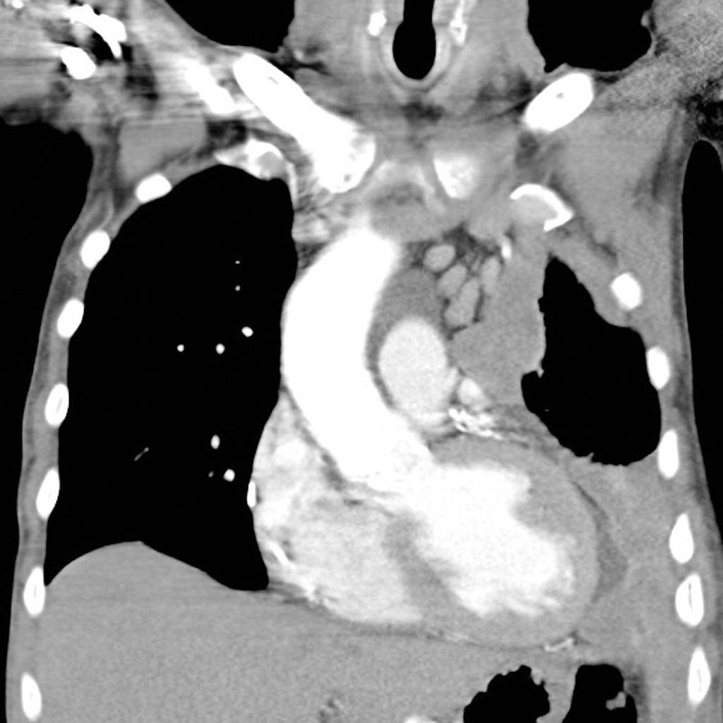 Mesothelioma - Wikipedia