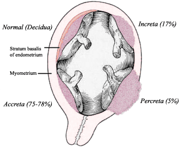 Placenta accreta — Wikipédia