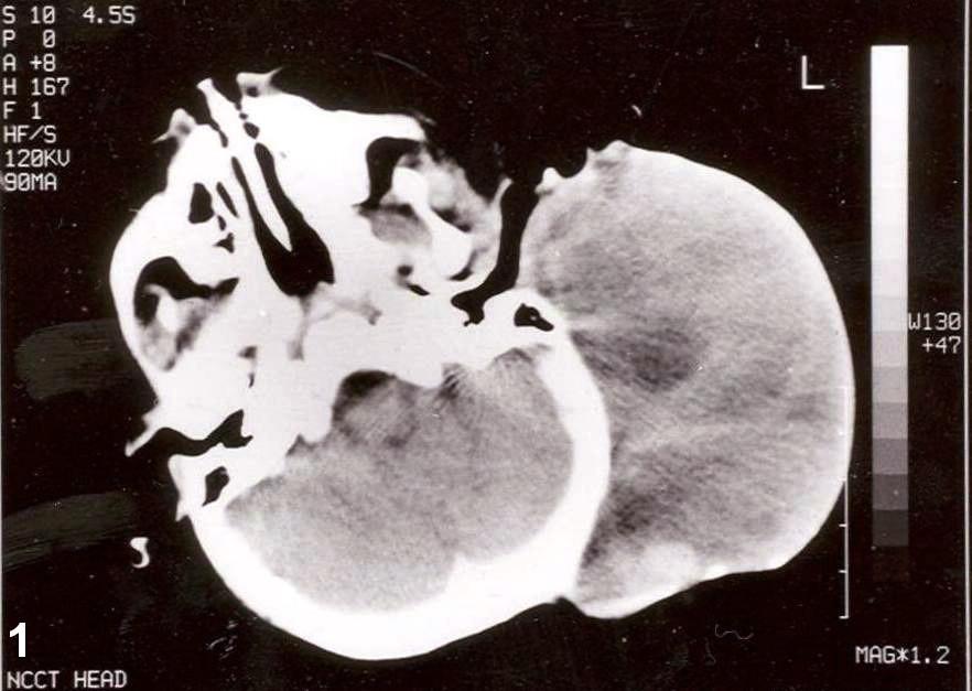 Rhabdomyosarcoma - Wikipedia