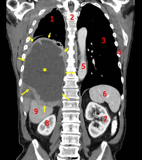 Cancer — Wikipédia