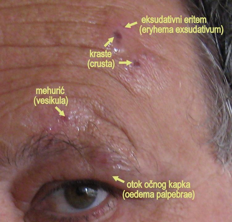 Herpes zoster ophthalmicus - Wikipedia