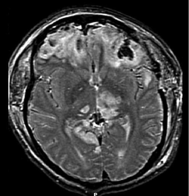 Acquired brain injury - Wikipedia