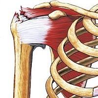 Rotator cuff tear - Wikipedia