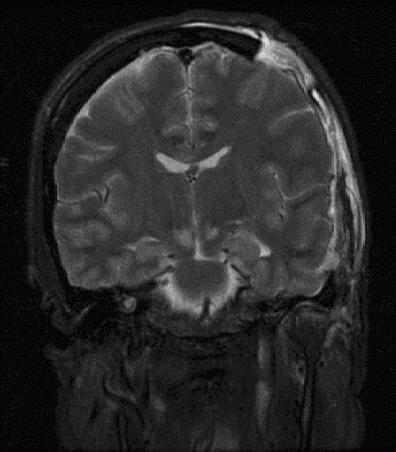 Intracranial pressure - Wikipedia