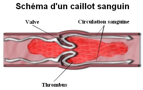 Thrombus — Wikipédia