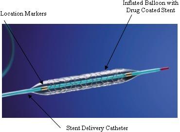 Coronary stent - Wikipedia