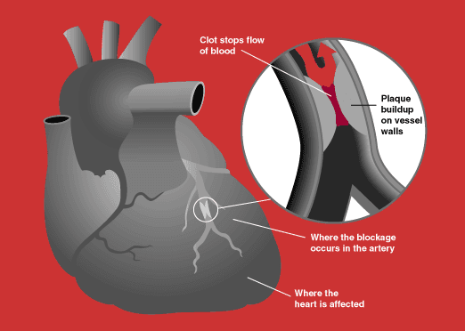 Acute coronary syndrome - Wikipedia