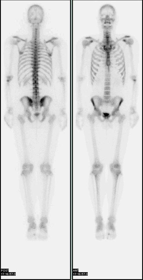 Bone scintigraphy - Wikipedia