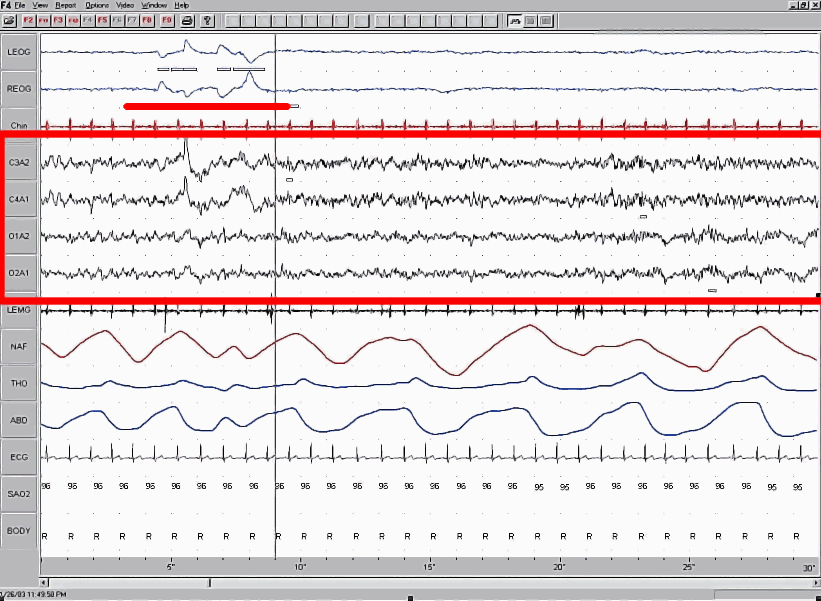 Polysomnographie — Wikipédia