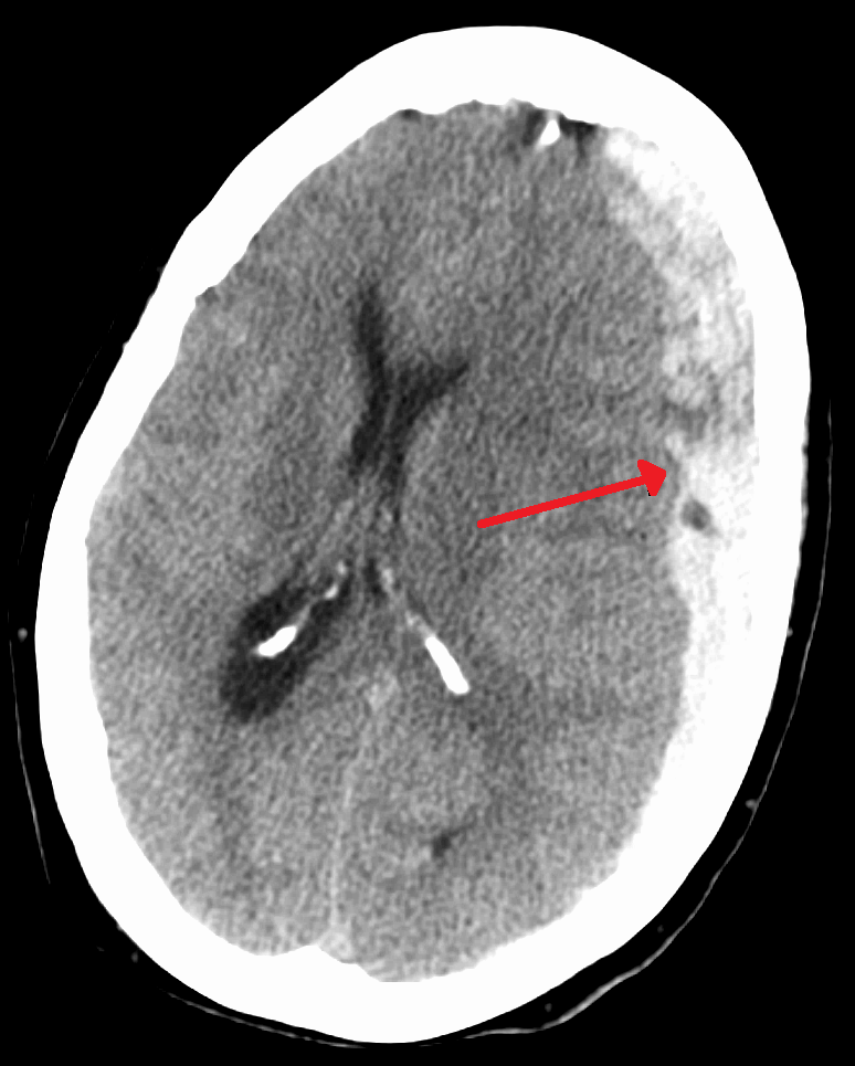 Subdural hematoma - Wikipedia