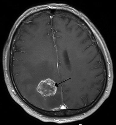 Brain tumor - Wikipedia