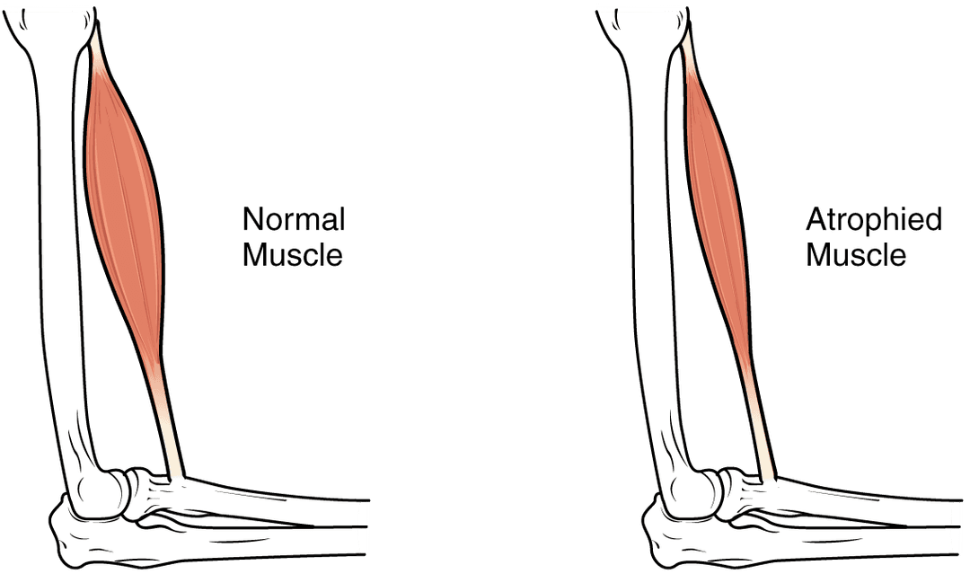 Sarcopenia - Wikipedia