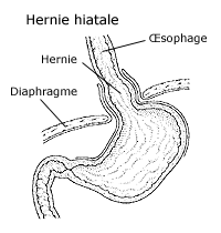 Hernie hiatale — Wikipédia