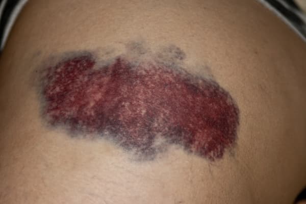 Bruise - Wikipedia