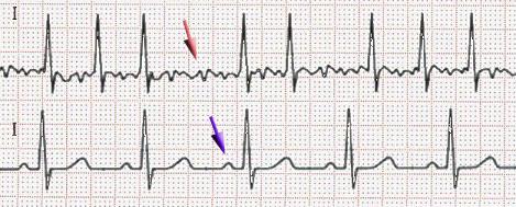 Atrial fibrillation - Wikipedia