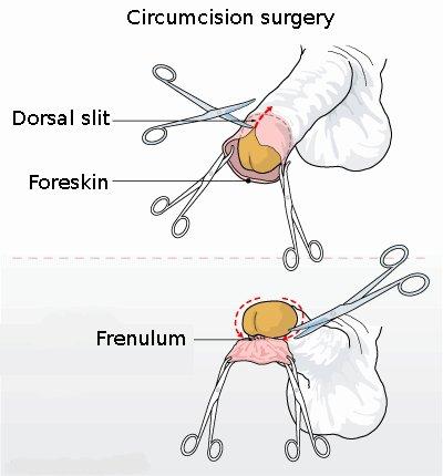 Circumcision - Wikipedia