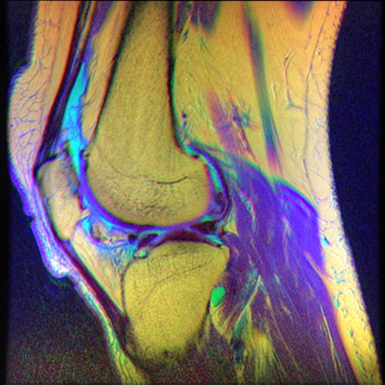 Chondromalacia patellae - Wikipedia