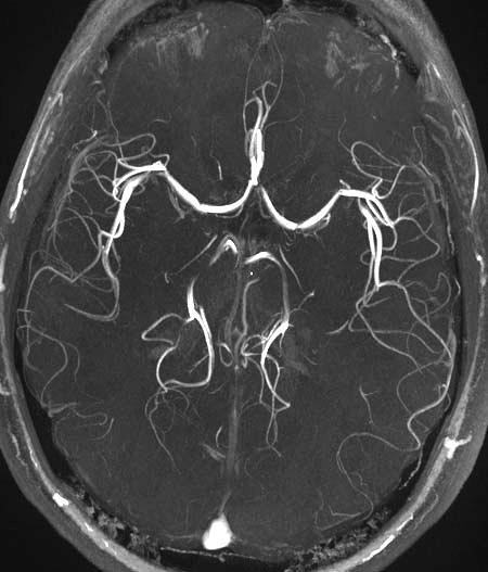 Magnetic resonance angiography - Wikipedia