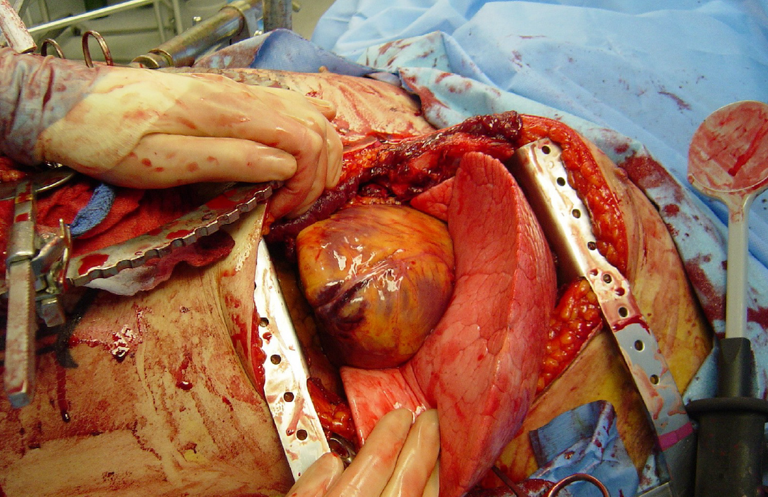 Thoracotomy - Wikipedia